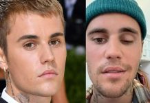 Justin Bieber Reveals Partial Face Paralysis. What’s wrong with him?